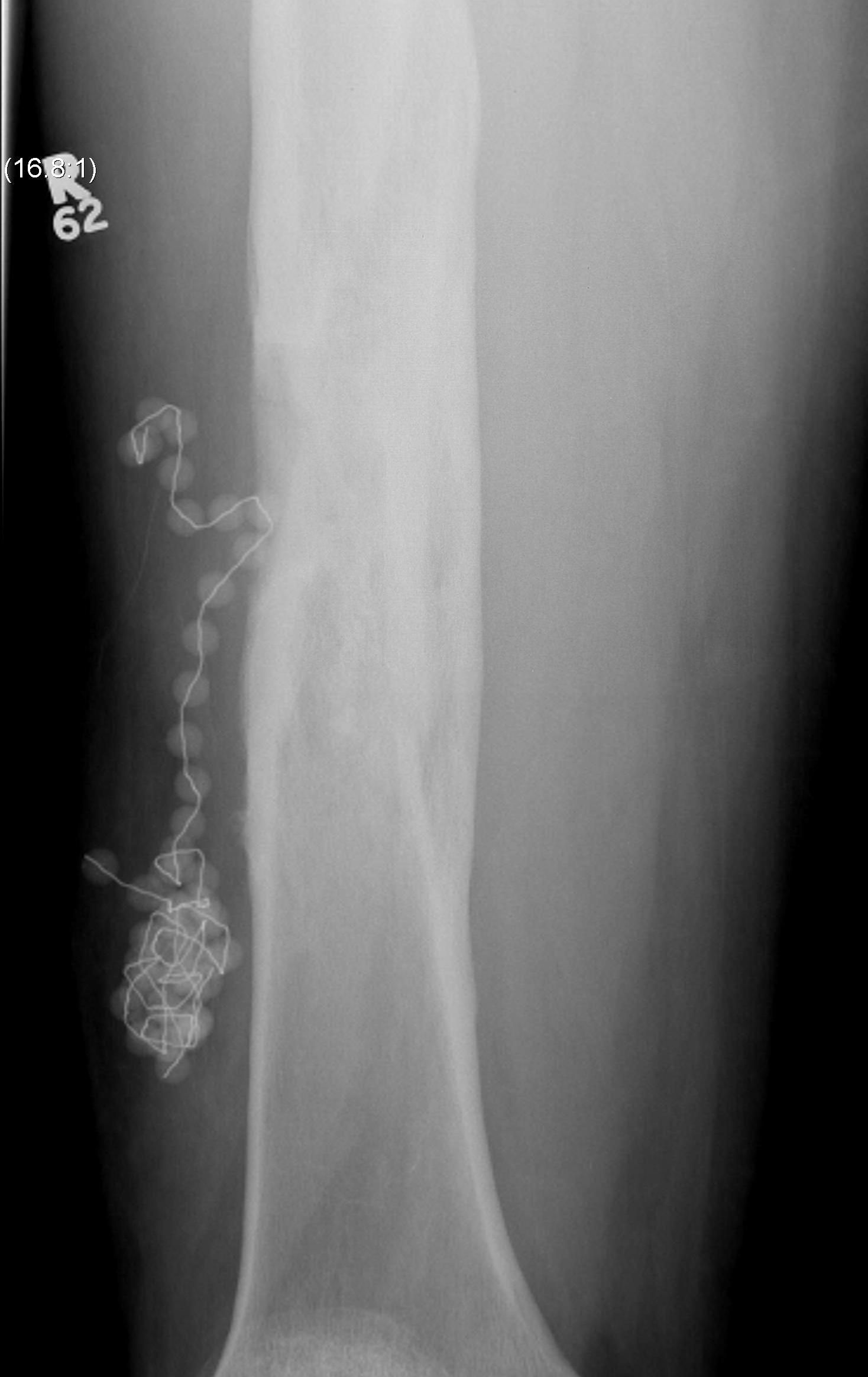 Chronic Osteomyelitis Femur AP